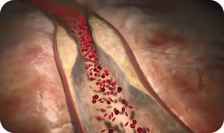下肢深部静脈血栓症